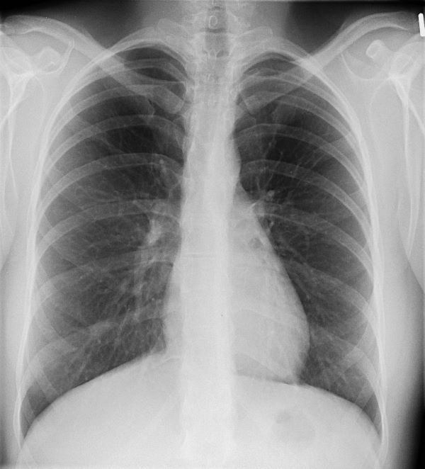 Roentgenbild einer Lunge